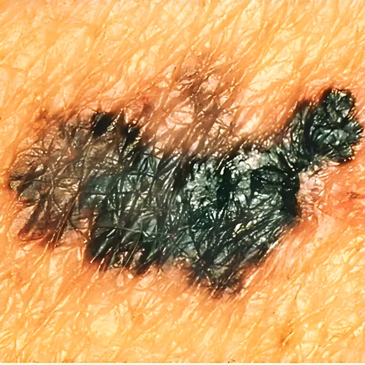 Lesão com várias cores, sinal de alerta