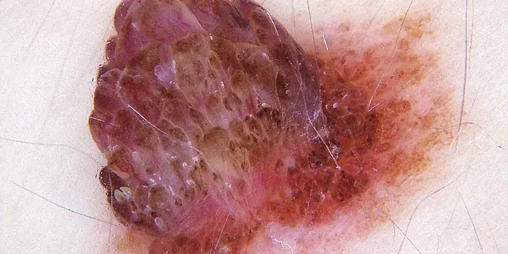Nevo melanocítico visto pelo dermatoscópio, com a estrutura da pinta ampliada